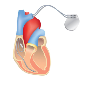 ICD Implantation