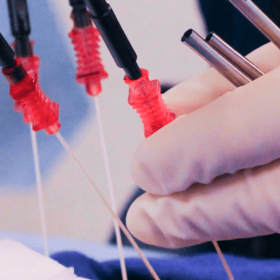 Atrial Fibrillation